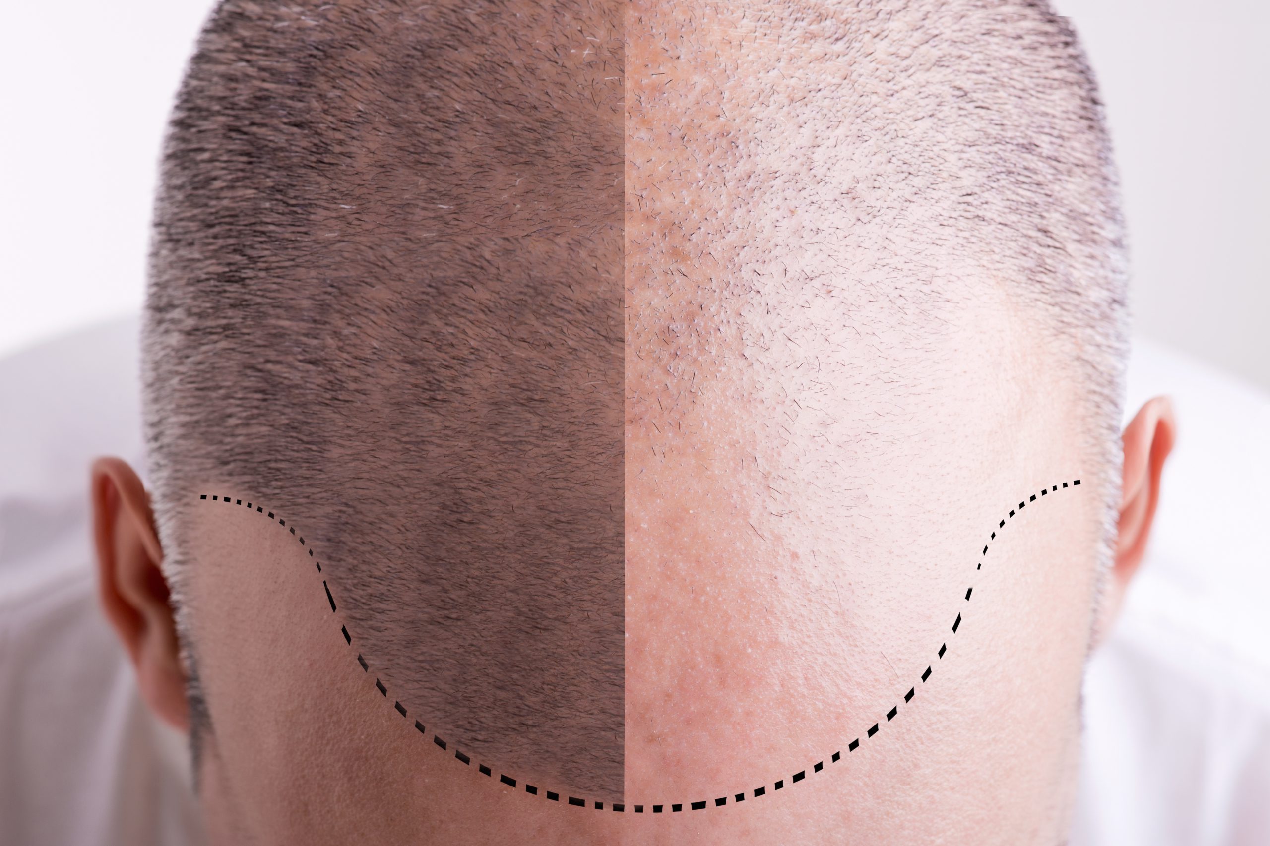 What makes a good candidate for Hair Transplant surgery? - Ape to Gentleman