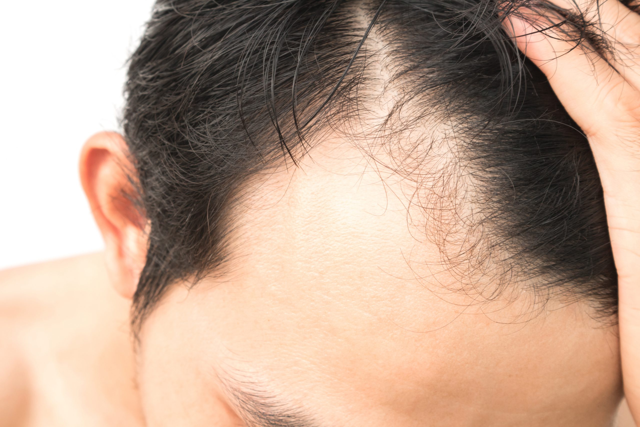 Hair Transplant Downtime Explained by An Expert