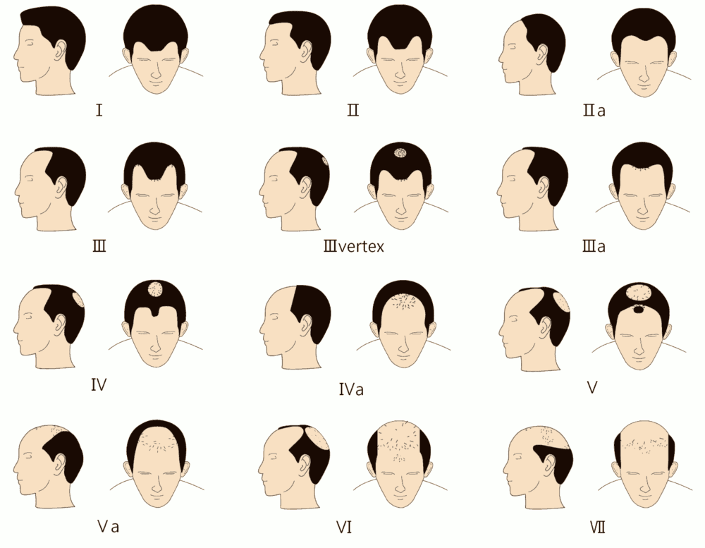 How To Deal With A Receding Hairline The Right Way