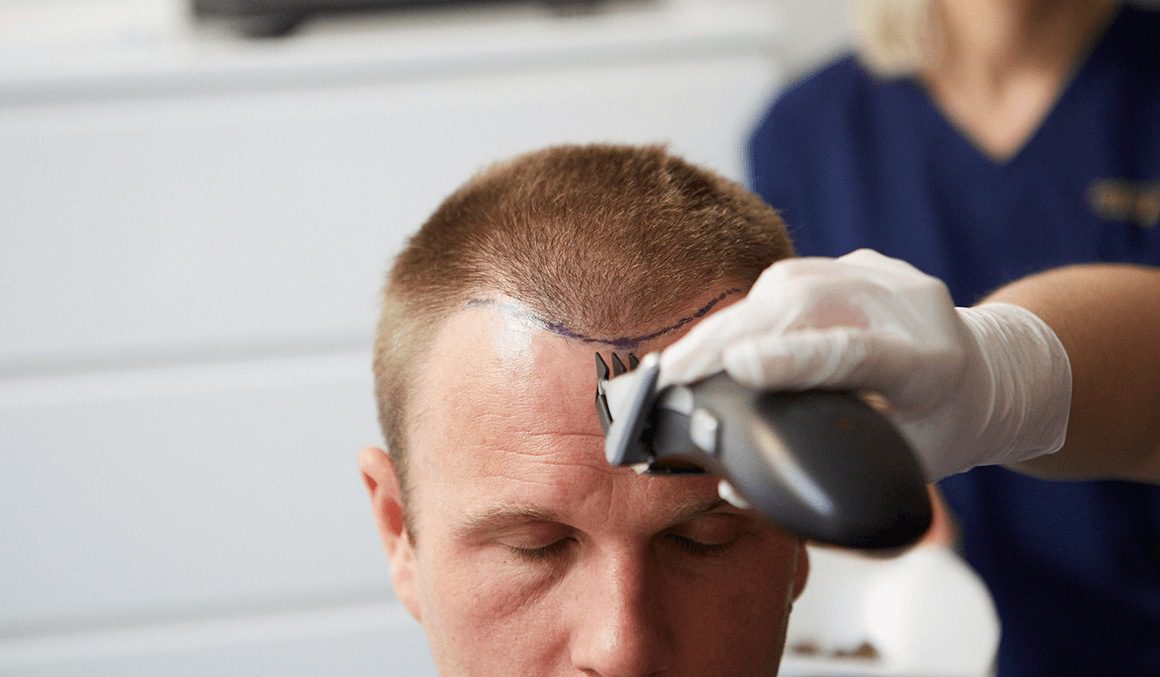 Fue Hair Transplant Nyc Quick guide To Save Anyone Some Headaches